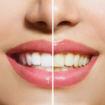 Smilelogic teeth whitening