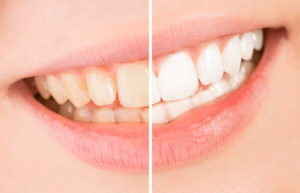 Broomfield teeth whitening