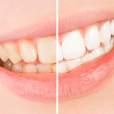 Broomfield teeth whitening