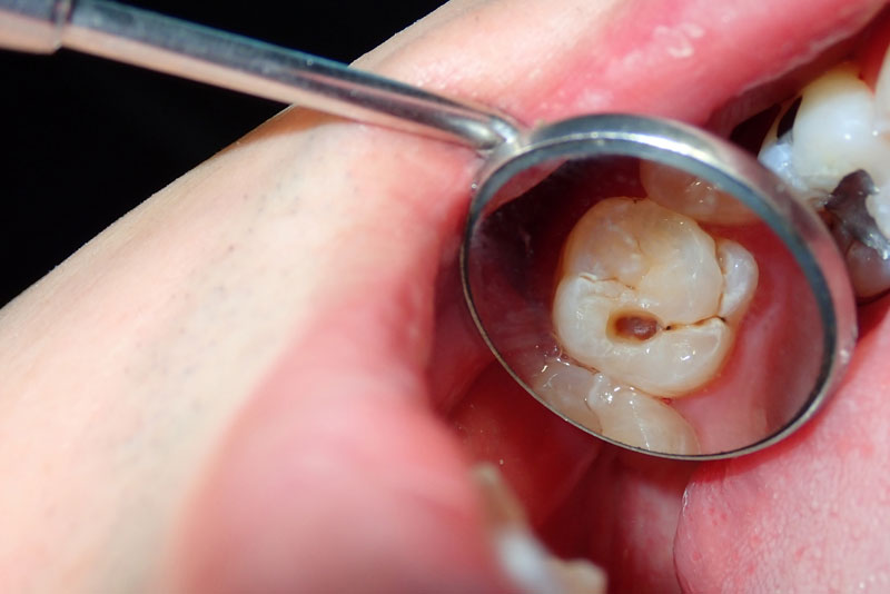 Caries Risk Assessment & Preventative Treatment in Broomfield, CO